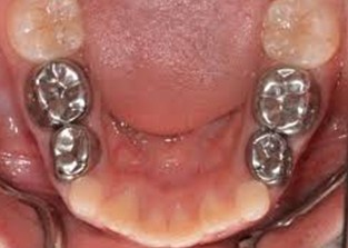 Stainless steel crown treatment for children photo 2